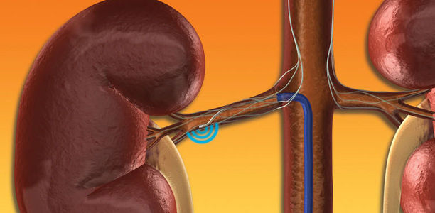 Bild zu Arterielle Hypertonie - Nierenarteriendenervation senkt Blutdruck signifikant