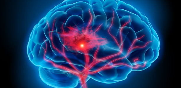 Bild zu Schlaganfallrisiko - Diabetes, Vorhofflimmern und Antikoagulation