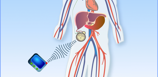 Bild zu Künstliches Pankreas - Blickpunkt: FDA und AP - zwei Welten prallen aufeinander