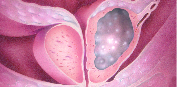 Bild zu Sexualstörungen beim Mann - Benignes Prostatasyndrom (BPS)