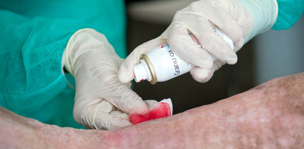 Bild zu Chronische Wunden - Hämoglobin-Spray sorgt für mehr Sauerstoff