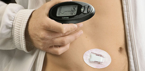 Bild zu Kostenerstattung - CGM: Was sagen die Kostenträger dazu?