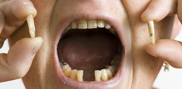 Bild zu Parodontitis - Folgen, Prävention, Therapie