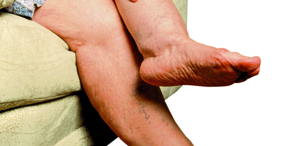 Bild zu Ödeme - Das Lymphödem und das Lipo-Lymphödem