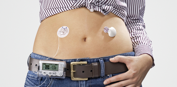 Bild zu IQWiG-Bericht:  - CGM hat Zusatznutzen