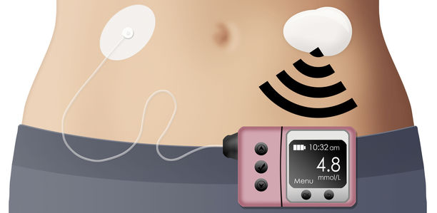 Bild zu CGMDiab - CGMDiab - was wissen wir zur Nutzung von kontinuierlichem Glukosemonitoring?