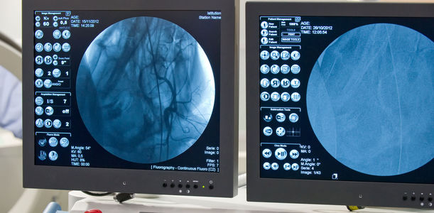 Bild zu Arteriosklerose - Intravenöse Hyaluronidase-Infusionstherapie bei austherapierter finaler Arteriosklerose