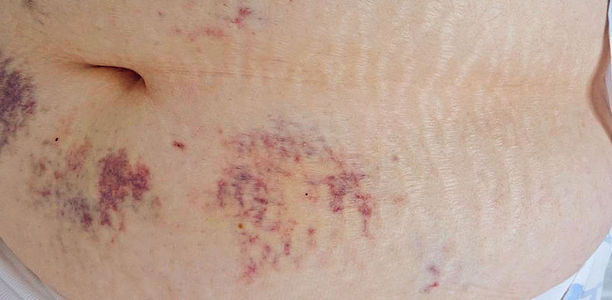 Bild zu „Aus der Praxis für die Praxis“ - Injektionsstellen inspizieren