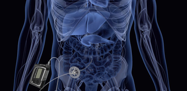 Bild zu Schwerpunkt: Insulinport - Neuer Weg bei der intraperitonealen Insulingabe