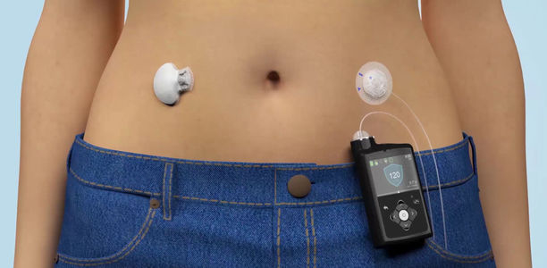 Bild zu „MiniMed 670G“ - Erstes Hybrid-Closed-Loop-System erhält CE-Kennzeichnung