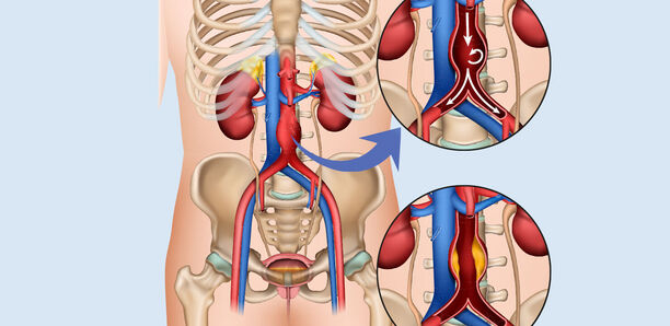 Bild zu Schwerpunkt „Gefäßerkrankungen“ - Aortenaneurysma