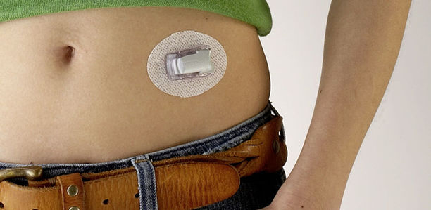 Bild zu Neue Vergleichsstudie - Messung der Gewebeglukose bei Patienten mit gestörter Hypoglykämiewahrnehmung