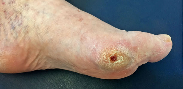 Bild zu BVKD - Die Diabetes-Kliniken - Komplikationen beim Diabetischen Fuß