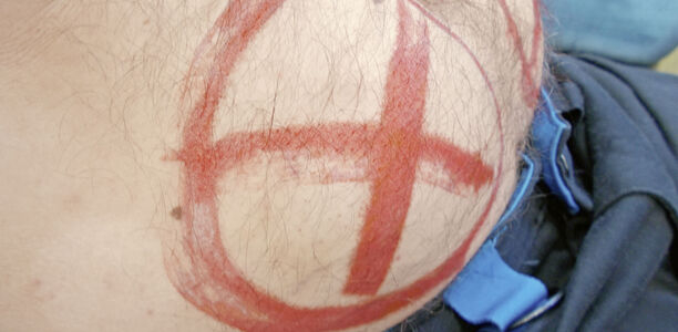 Bild zu Aus der Praxis: „Unglaubliche“ Erlebnisse - Spritzstellen – Patienten und ihre „Lieblings-Quadratzentimeter“