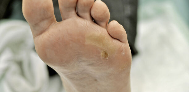 Bild zu Verbrennungen und Diabetes mellitus - Behandlung von Verbrennungswunden mit Kaltplasma