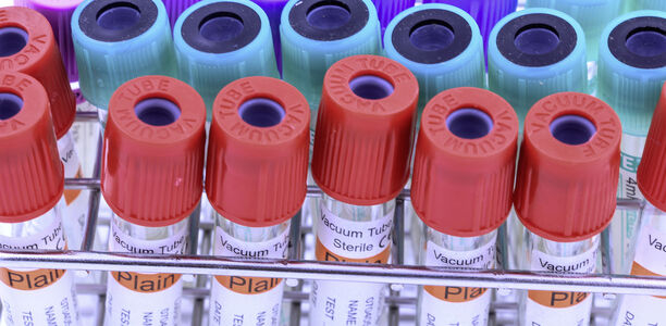 Bild zu COVID-19 - Klinische Studie zu Passivimmunisierung gestartet