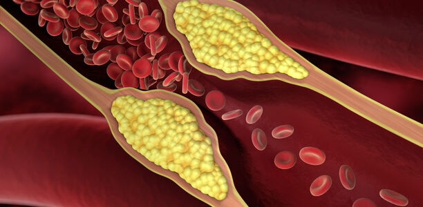 Bild zu Schwerpunkt „Herz und Gefäße“ - Die periphere arterielle Verschlusskrankheit