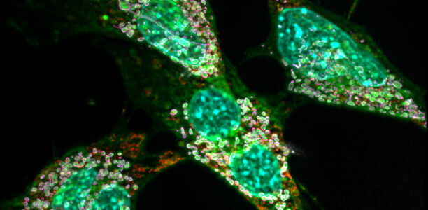 Bild zu Forschung - Fettkristalle lösen chronische Entzündungen aus