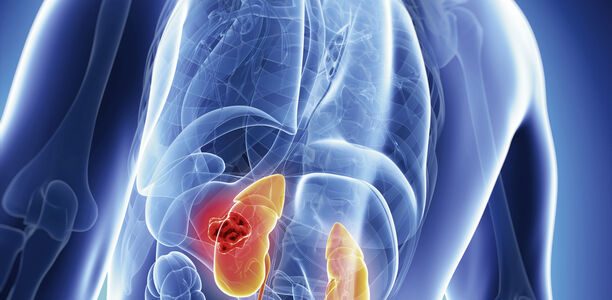 Bild zu SGLT2-Hemmer - Hoffnung für Herz und Nieren