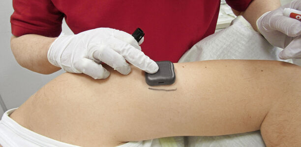 Bild zu Kommentar - Erstattungsfähigkeit eines implantierbaren Real-Time-Glukosemessgeräts