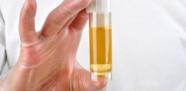 Bild zu Schwerpunkt: Urologie - Urindiagnostik: Mehr als nur Geruch und Farbe 