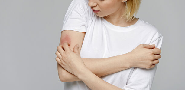 Bild zu Irritationen und Allergien - Unerwünschte Hautreaktionen auf CGM-Systeme