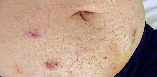 Bild zu Lipohypertrophien - Injektion: Vorsicht bei Lipohypertrophien