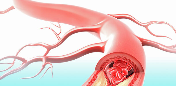 Bild zu Arteriosklerose - Gute Blutzuckereinstellung schützt Gefäße