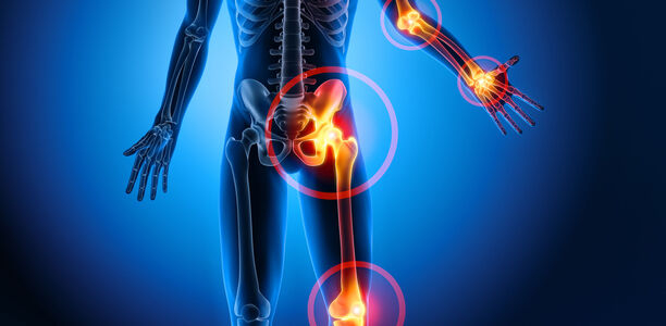 Bild zu Symptomatische Hyperurikämie - Fruktosekonsum kann Gicht begünstigen