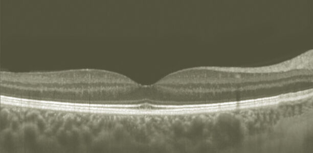 Bild zu Typ-1-Diabetes - Neurodegenerative Veränderungen der Retina bei pädiatrischen Patienten mit Typ-1-Diabetes