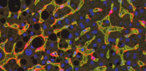 Bild zu NASH - Immunzellen treiben entzündliche Fett-Lebererkrankung an