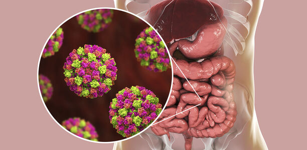 Bild zu Schwerpunkt „Gastrointestinaltrakt“ - Gastroenteriden: Noroviren sind oft ursächlich