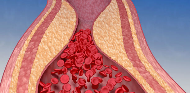 Bild zu Embolien und Mortalität - Wie sich die Pandemie auf die Gefäßgesundheit auswirkt