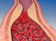 Bild zu Embolien und Mortalität - Wie sich die Pandemie auf die Gefäßgesundheit auswirkt