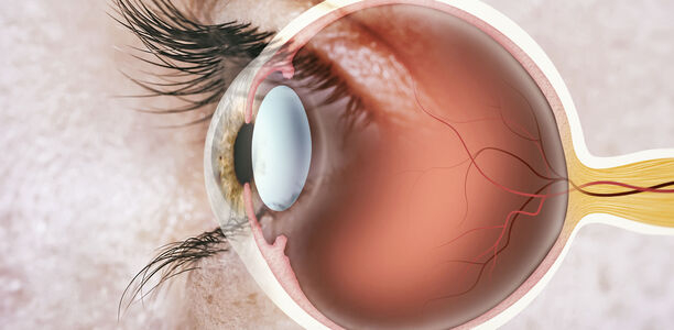 Bild zu Typ-1-Diabetes - Diabetesinduzierte Veränderungen des Auges