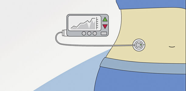 Bild zu Schwerpunkt AID-Systeme - Technologie für die Insulinabgabe