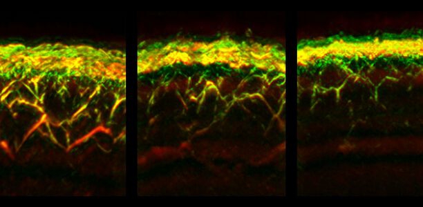 Bild zu Diabetes untersuchen mit Hautscanner und KI - Optoakustisches Bildgebungsverfahren RSOM zeigt Schwere der Erkrankung