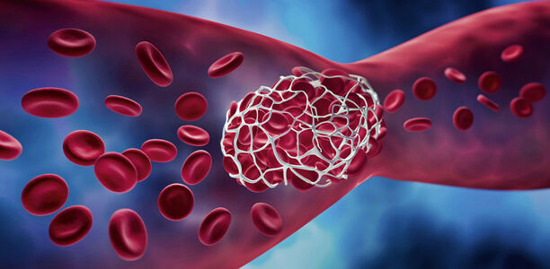 Bild zu Fortbildung - Thrombose, Inflammation und Blutgerinnung