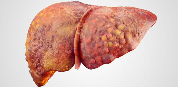 Bild zu CME - Fettleber und Diabetes