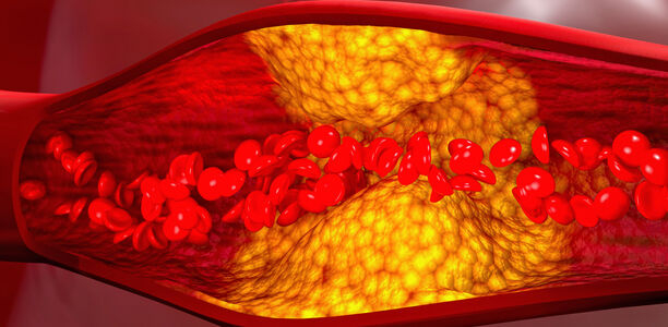 Bild zu Schwerpunkt "Herz und Gefäße" - Update Diagnostik und Therapie der KHK