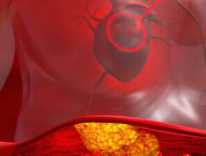 Bild zu Schwerpunkt "Herz und Gefäße" - Update Diagnostik und Therapie der KHK