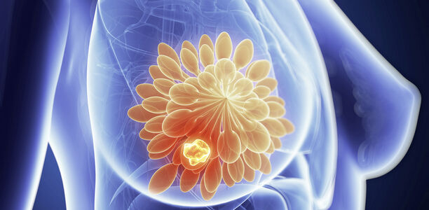 Bild zu Schwerpunkt "Ernährung" - Diabetes-Risiko nach Brustkrebs